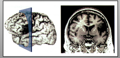 Broca's Aphasia