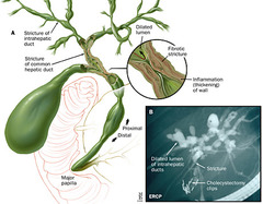 Cholangitis