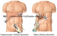 Cholecystectomy