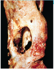 Chronic Osteomyelitis