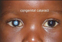 Congenital Cataract