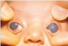 Congenital Glaucoma