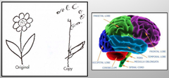 Contralateral Neglect Syndrome