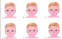 Craniofacial Clefts