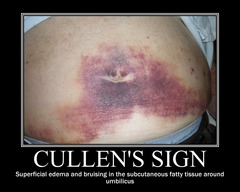 Cullen's sign
