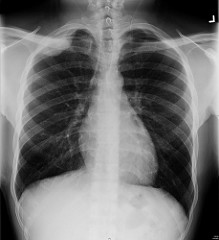 CXR