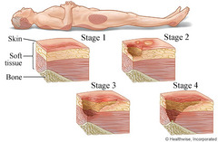 Describe a Stage I pressure ulcer