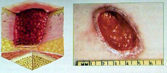 Describe a Stage III pressure ulcer