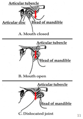 Dislocated TMJ