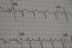 ECG (EKG)