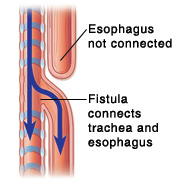 esophageal atresia (EA)