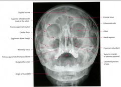 Evaluating Facial Bones w/ Radiology