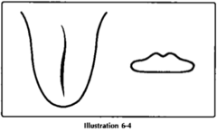 If the tongue body is *SWOLLEN along a CENTRAL CRACK*, what might that indicate?