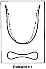 If the tongue body is *SWOLLEN at the SIDES*, what might that indicate?