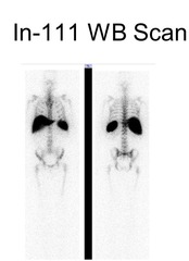 Indium 111 WBC scan