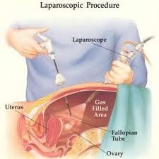 Laparoscopy