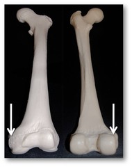 lateral condyle