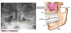 Maxillary Sinusitis