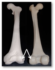 medial condyle