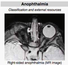 Microphthalmia and Anophthalmia