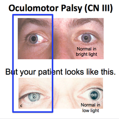 Oculomotor Palsy (CN III)