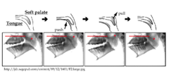 Oropharyngeal Dysphagia