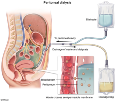 Peritoneal dialysis