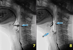 Post-swallowing/Repositioning