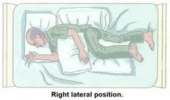 Side-lying Positioning