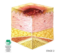 Nursing Interventions Wound Care - Flashcards | StudyHippo.com