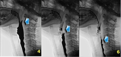 Swallowing Reflex - Pharyngeal Phase