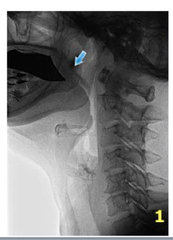 Swallowing Reflex - Preparatory Phase