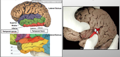 Temporal Lobe Subdivision - Auditory Cortex