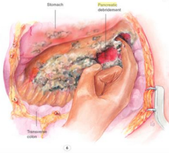 Treatment of pseudocyst