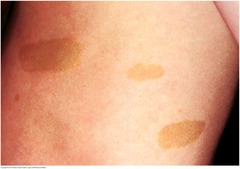 What are café au lait spots? Any follow up required for these birthmarks?