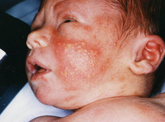 What is Erythema Toxicum?