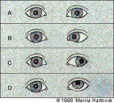 What is strabismus? is this normal?
