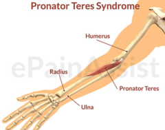 ___1___: median nerve compression between two heads of pronator teres   -Cause: repetitive pronation & supination & excessive pressure on VOLAR forearm   -Sxs: same as CTS & also pain in proximal forearm, but NO NIGHT SXS (daytime only)  -Positive ___2___ sign