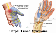 ___1___: -Median nerve compression   -Cause: repetition, awkward postures, vibration, anatomical anomalies, pregnancy   -Symptoms: numbness & tungling go the thumb, index, middle & radial half of ring fingers: Paresthesias usually OCCUR AT NIGHT* (most characteristic sx)  -Positive ___2-3___ signs  *Advanced stage can result in muscle atrophy of the thenar eminance