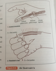 ____1___:  -Stenosing tenosynovitis of abductor pollicus longus (APL) and extensor pollicus braves (EPB)  -Causes pain & swelling over radial styloid   -Positive ___2___