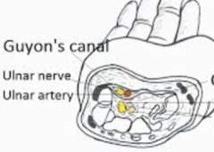 ____1____: ulnar nerve compression at the wrist   Cause: repetition, ganglion, pressure, fascia thickening   Symptoms:  -Numbness & tingling in ulnar nerve distribution of hand  -Motor weakness of ulnar nerve-innervated musculature -Positive ____2___ sign at the canal (AKA ulnar canal) -Advanced stages can lead to muscle atrophy of ulnar-innervated musculature of hand