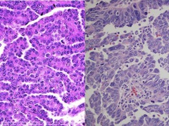 2 categories of serous carcinoma of the ovary