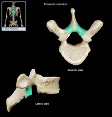 34-year-old man with herniated lumbar intervertebral disc. Laminectomy and removal of hernia scheduled. CT scan of vertebrae shown, which is surgical entrance location into neural canal?