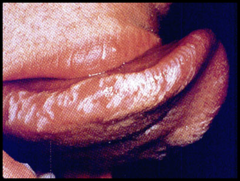 a clinical white patch/plaque that does not rub off and does not clinically represent any other condition (not used for lesion description) (need biopsy to use this word)