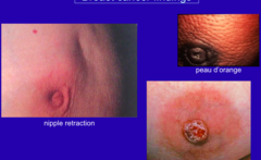 Abnormal Findings  Signs of Retraction & inflammation