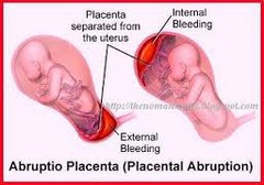 Abruptio placentae