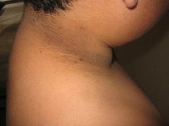 *Acanthosis nigricans*  Hyperpigmented velvety plaques in axilla and neck