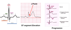 ACUTE HEART FAILURE: EKG manifestations of Damage to the myocardium