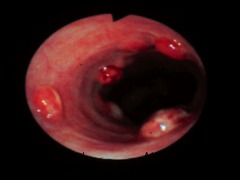 Adenocarcinoma