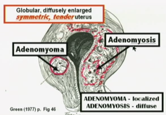 Adenomyosis: definition, presentation, diagnosis, Sx, examination, imaging, management